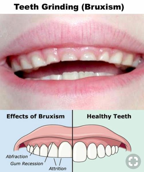 causes of teeth grinding in children at night